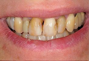 Alan Wolkoff, D.M.D. | Teeth Whitening, Dentures and Veneers